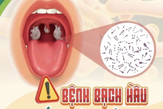 Bệnh bạch hầu: Đặc biệt chú ý khi giả mạc lan rộng- Ảnh 1.
